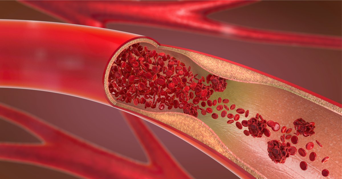 مشاكل الشرايين والأوردة الوراثية: دليل شامل من مستشفى عبيد التخصصي