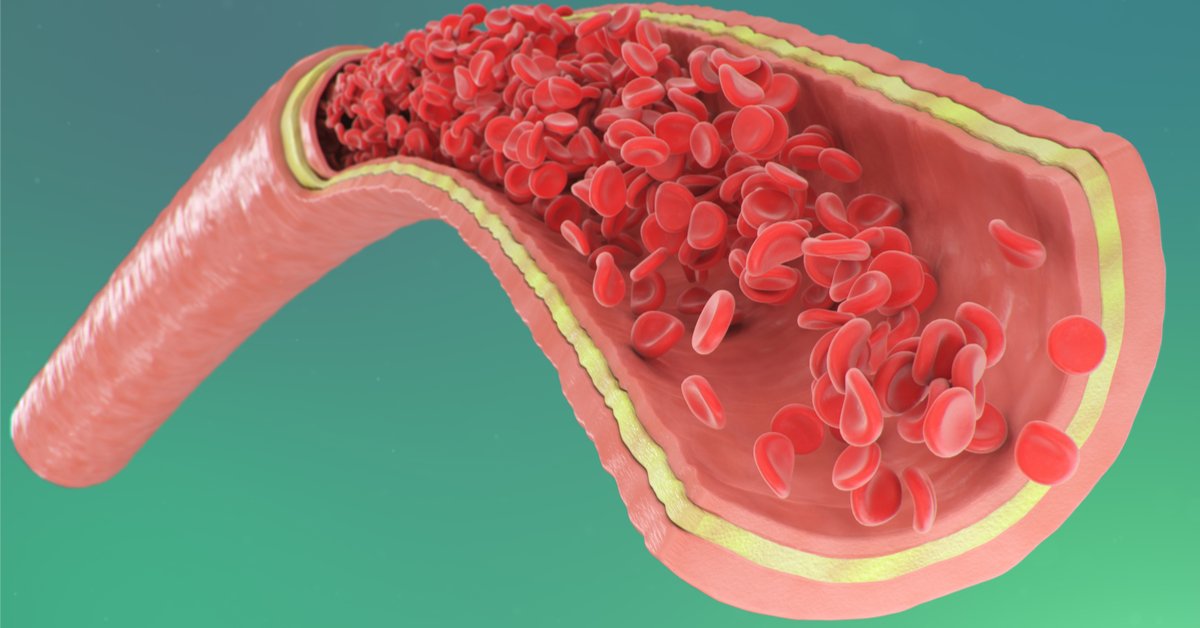 كيف يمنع التشخيص المبكر مضاعفات خطيرة في أمراض الشرايين في مستشفى عبيد التخصصي بالرياض والأحساء