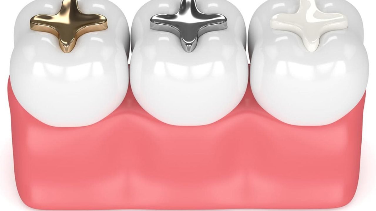 ما هي أنواع حشوات الأسنان وكيف يتم اختيار النوع المناسب لك في مستشفى عبيد التخصصي بالرياض والأحساء؟