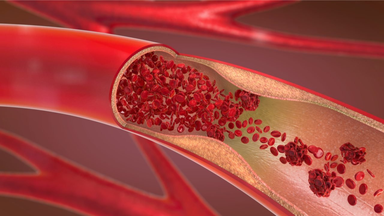 مشاكل الشرايين والأوردة الوراثية: دليل شامل من مستشفى عبيد التخصصي