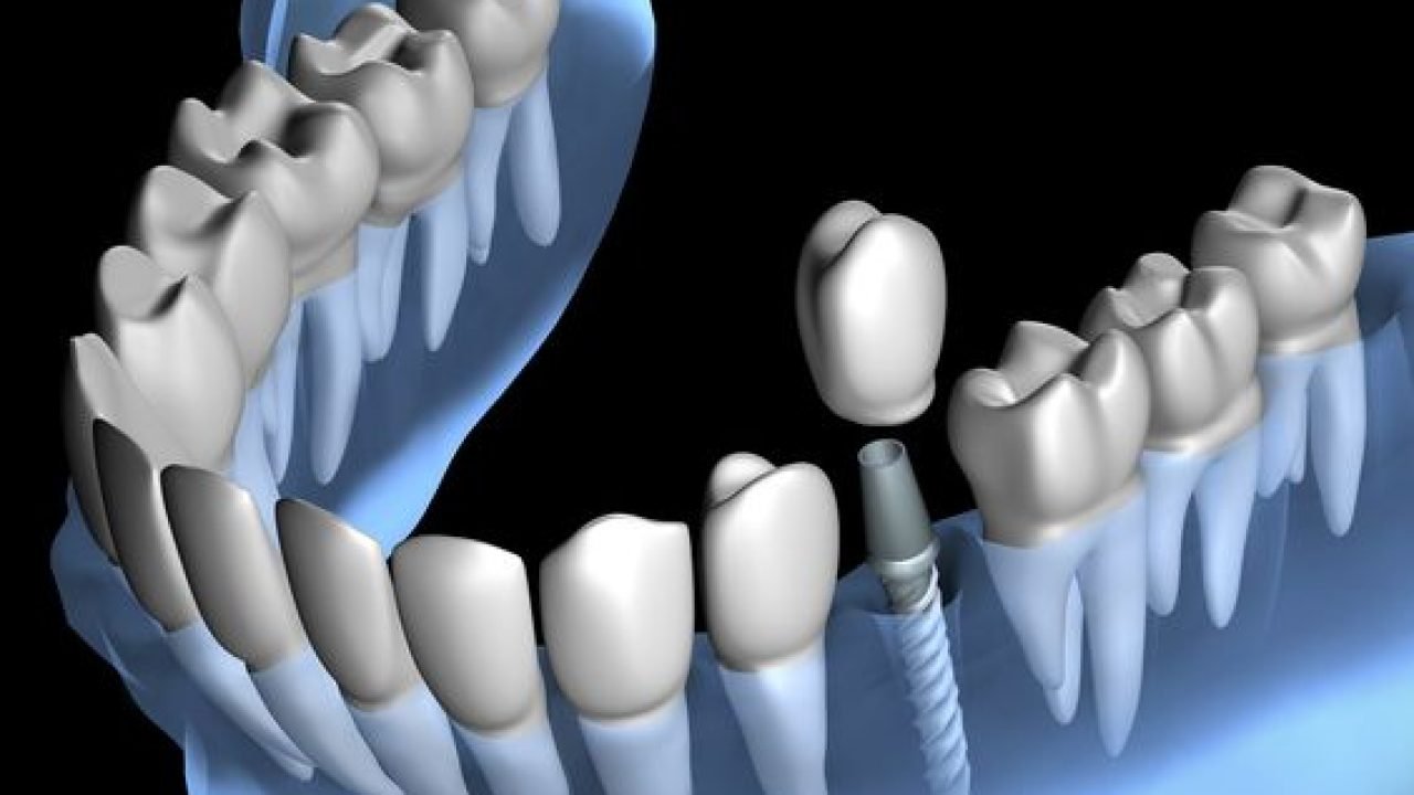 زراعة الأسنان في مستشفى عبيد التخصصي بالرياض والأحساء – أحدث التقنيات وأفضل نتائج الزراعة في المملكة