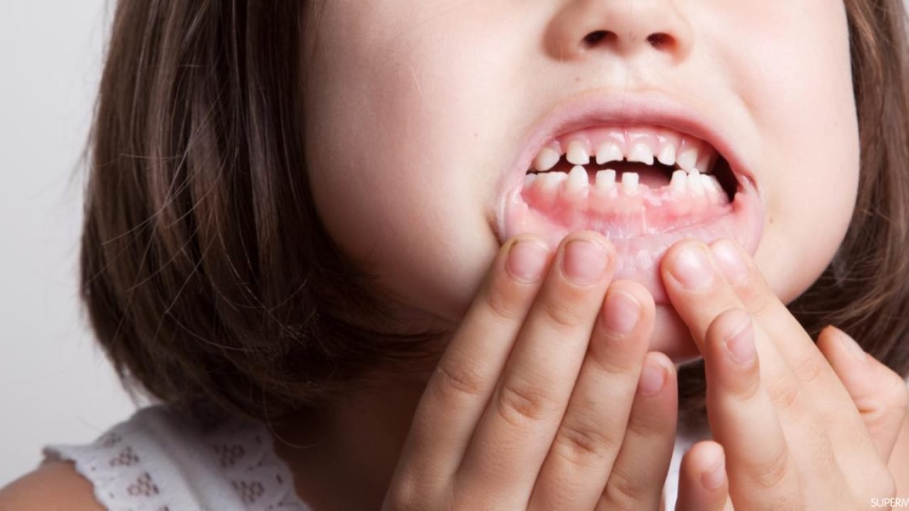 أعراض ضعف مينا الأسنان عند الأطفال وأفضل طرق علاجها في مستشفى عبيد التخصصي بالرياض والأحساء