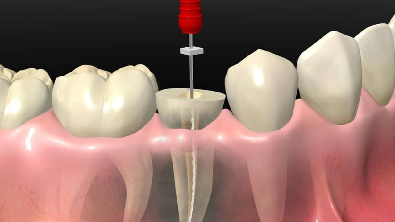 حشو الأسنان في مستشفى عبيد التخصصي بالرياض والأحساء – دقة عالية ورعاية شاملة تجعلها الأفضل في المملكة